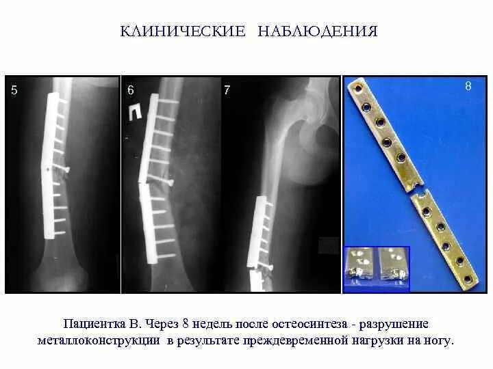 Экстракортикальный остеосинтез. Трансспонгиозный остеосинтез. Остеосинтез аутокостью. Осложнения остеосинтеза