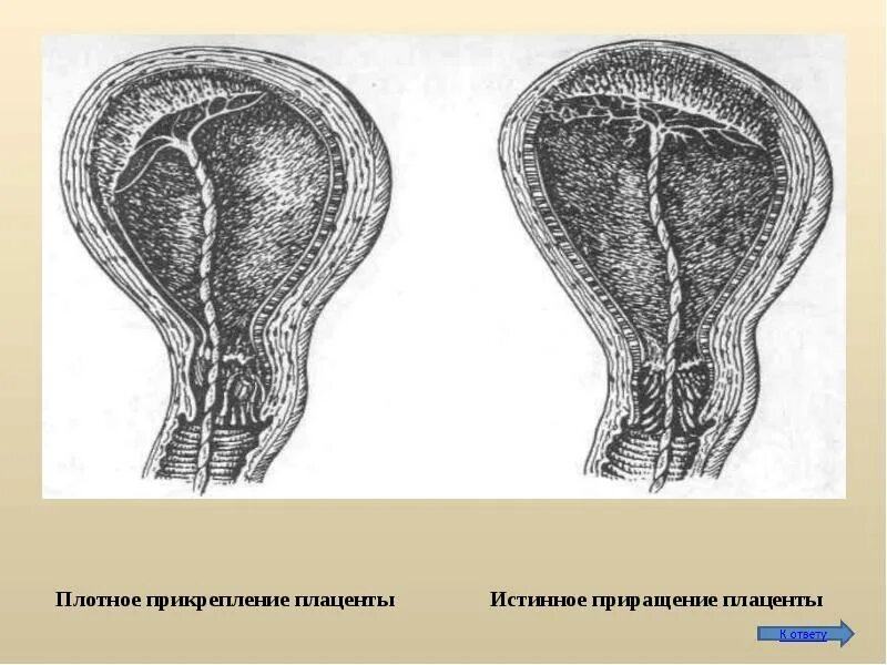 Частичное истинное приращение плаценты. Плотное приращение плаценты. Аномалии врастания плаценты. Полное истинное приращение плаценты. Плацента на рубце матки