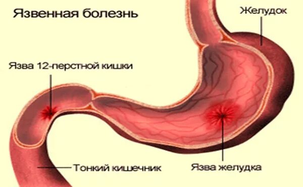 Болезни двенадцатиперстной кишки у ребенка. Язвенная болезнь 12 перстной кишки у детей. Язва желудка и 12 перстной кишки у детей. Язвенная болезнь желудка и 12пк. Язвенная болезнь желудка и 12 перстной кишки у детей.