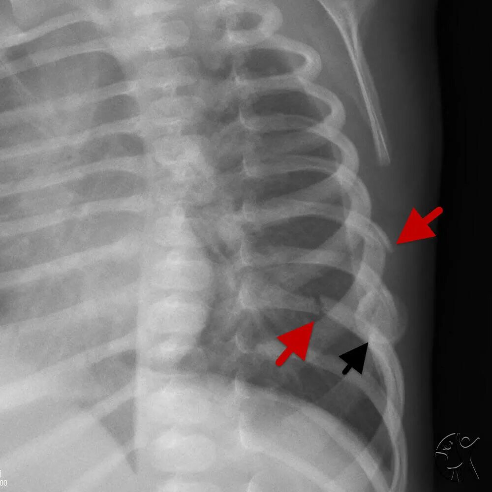 Трещина бок. Перелом ребра снимок рентген. Оскольчатый перелом ребра рентген. Компрессионный перелом ребер.