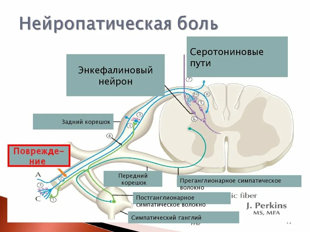 Нейропатическая боль в спине. Механизм нейропатической боли. Хроническая нейропатическая боль. Нейропатическая боль механизм возникновения. Механизм формирования нейропатической боли.