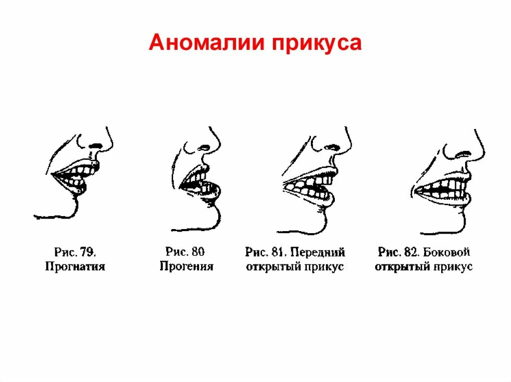 Нижняя артикуляция. Правильный прикус у человека схема сбоку. Схема аномальных видов прикуса. Виды прикуса прогнатия прогения. Аномалии прикуса в логопедии.