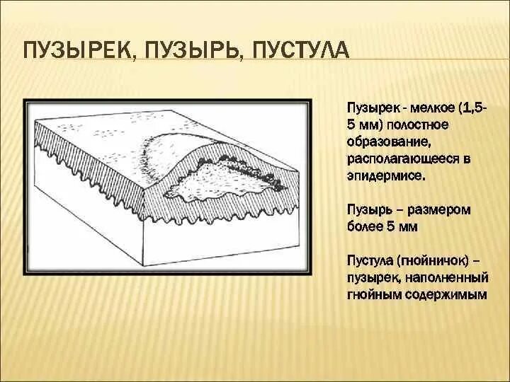 Первичные полостные элементы. Пузырь и пузырек дерма отличия. первичные морфологические элементы сыпи везикула пузырь. первичные полостные элементы сыпи.