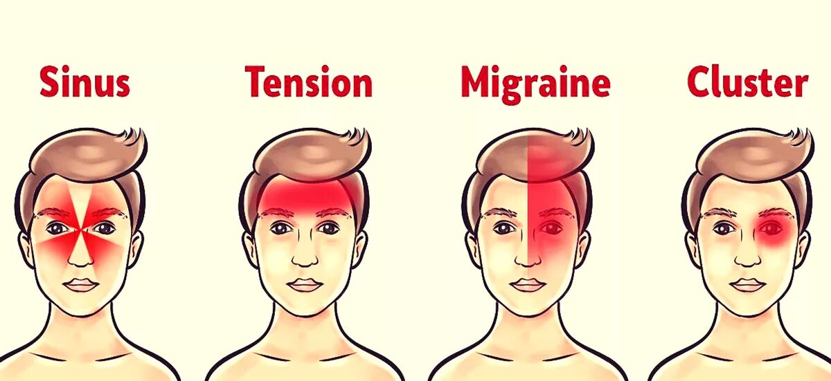 Где болит при мигрени. Различие головной боли. Головная боль при мигрени. Types of headache. Отличие мигрени от головной боли.