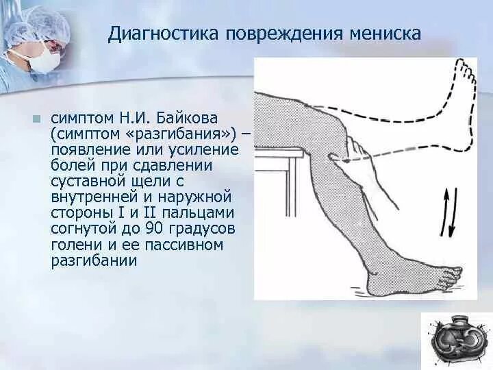 Для перелома характерно тест. Симптомы повреждения менисков коленного сустава. Диагностика повреждения менисков. Тесты при повреждении мениска.