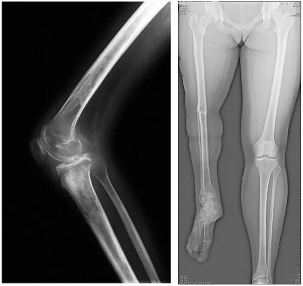 Саркома тазобедренного. Остеосаркома большеберцовой кости. Остеосаркома бедренной кости. Саркома Юинга большеберцовой кости рентген.