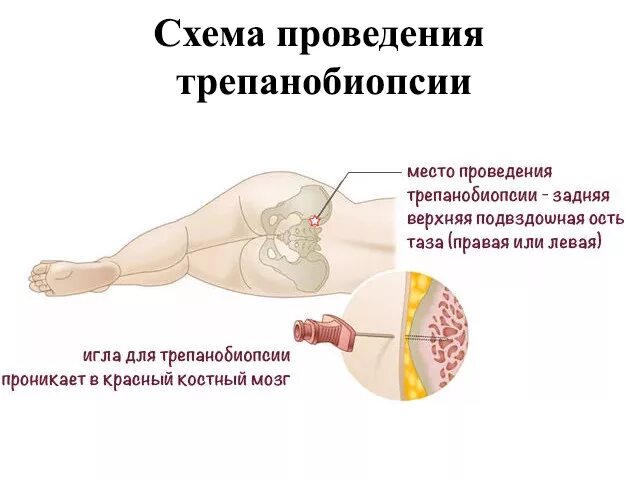 Трепанобиопсия подвздошной