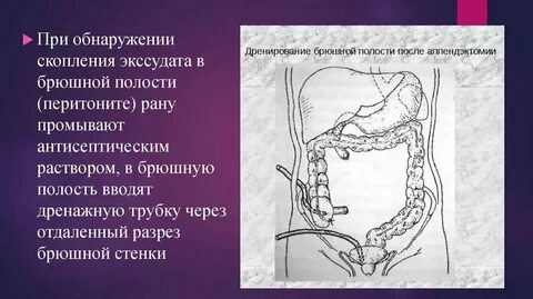 Реабилитация после операции аппендицита
