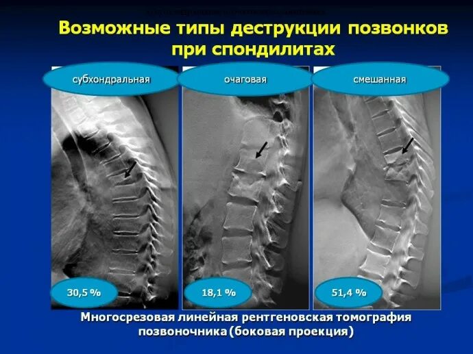Деформация позвоночных. Спондилодисцит позвоночника. деструкция позвоночника. деформация позвонков по типу рыбьих. деструкция тела позвонка.
