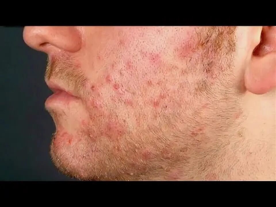 Как выглядит фолликулит на лице Фолликулит