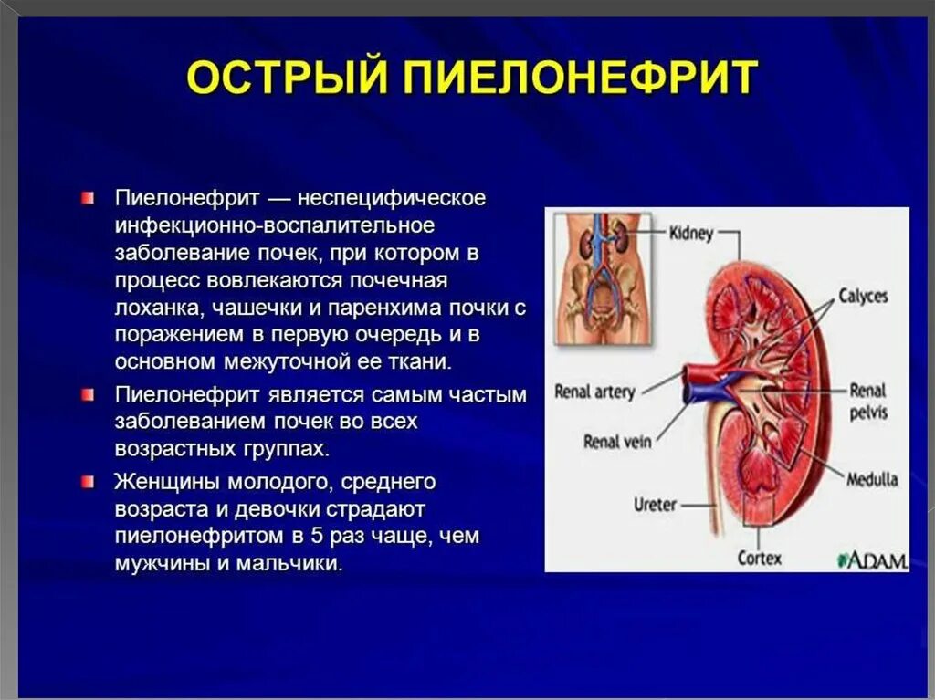 1 острый пиелонефрит