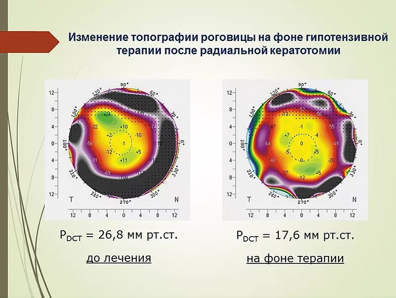 кератотопография астигматизм. кератотопография глаза норма. топография роговицы. кератоконус кератотопограмма. топография роговицы.