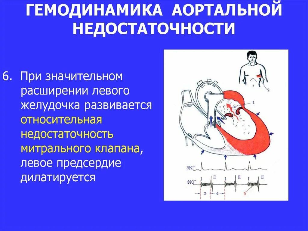 Митральная недостаточность гемодинамика схема. Недостаточность клапана аорты гемодинамика. Изменения сердца при недостаточности митрального клапана. Гемодинамика при митральной недостаточности схема. Гемодинамика пациента