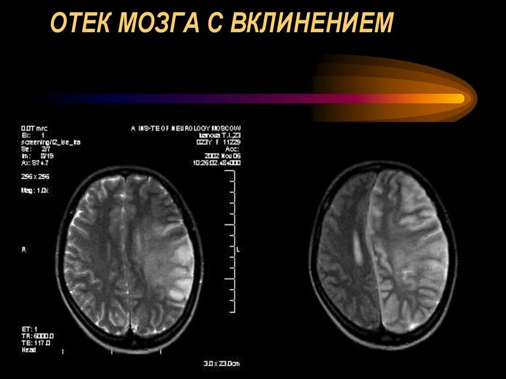 Реактивный отек мозга