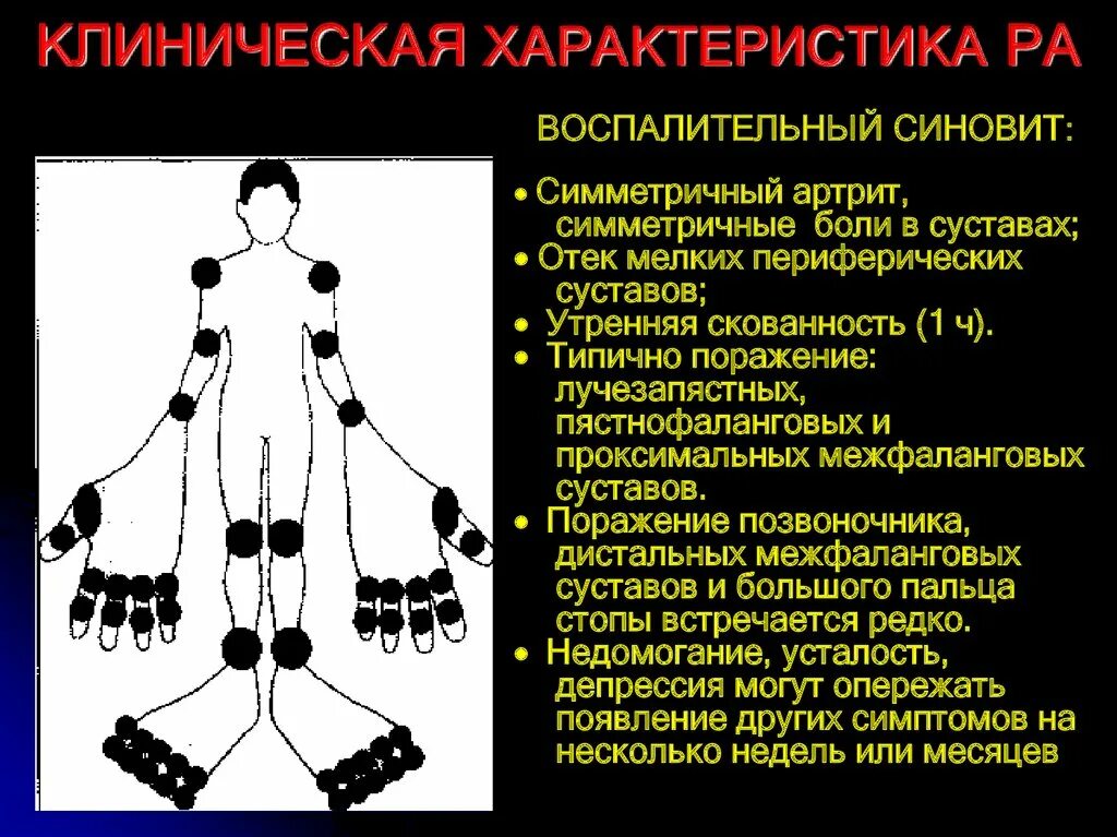 симметричные суставы. симметричные суставы. симметричные суставы. симметричные суставы. ревматоидный артрит проксимальные межфаланговые.