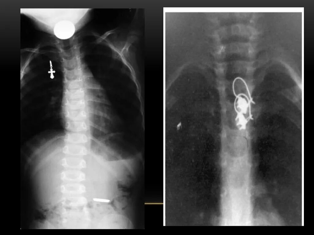 Инородное тело пищевода рентген. Эзофагоскопия инородное тело пищевода. Рентген инородное тело в ЖКТ. Инородное тело в желудке рентген.