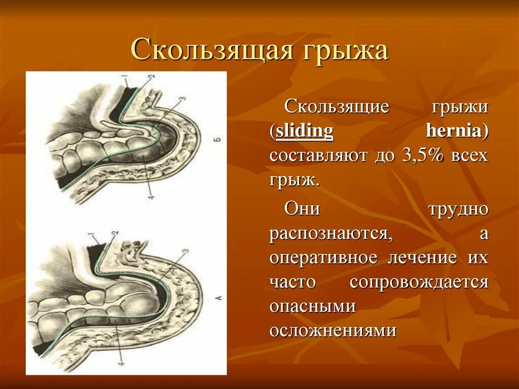 Может ли быть грыжа. Скользящая пупочная грыжа. скользящие грыжи живота. скользящая бедренная грыжа.
