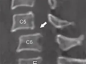 Патологии развития позвоночника у подростка. Подвывих в атланто-аксиальном суставе. Подвывих шейного атланта. Ротационный подвывих атланта с1. Ротационный подвывих атланта с1.