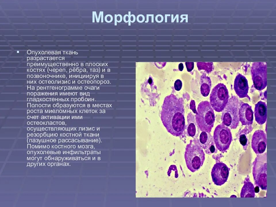 Гемобластозы — заболевания кроветворной ткани:. Гемобластозы морфология. Гемобластозы классификация. Гемобластозы с первичным поражением костного мозга.