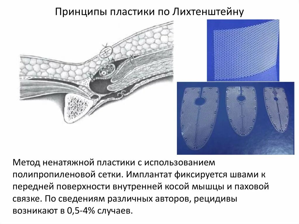 Операция Лихтенштейна при паховой грыже схема. Паховая грыжа операция герниопластика по Лихтенштейну. Паховая грыжа операция по Лихтенштейну. Методика Лихтенштейна при паховой грыже. Лихтенштейн операция паховая