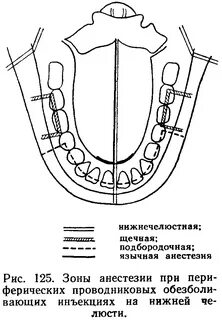 Анестезия верхней челюсти