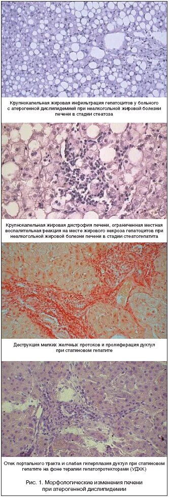 Неалкогольная жировая печень клинические рекомендации. Жировая инфильтрация гепатоцитов. Крупнокапельная жировая дистрофия гепатоцитов. Жировая крупнокапельная инфильтрация печени. Крупнокапельный стеатоз.