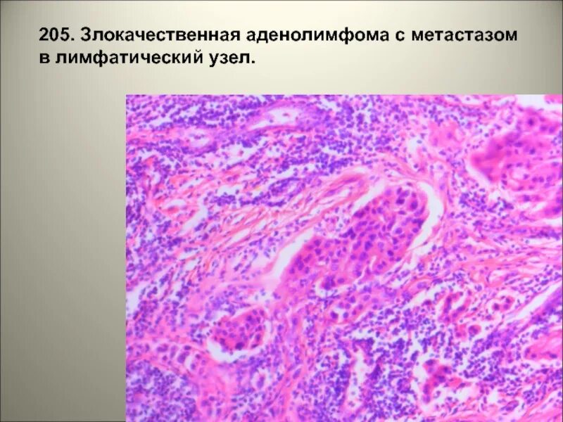 Метастазы в лимфоузлах при раке молочной