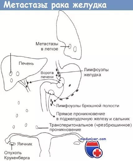 Метастазирование желудка. Метастазы в лимфоузлы ворот печени. Схема метастазирования желудка.