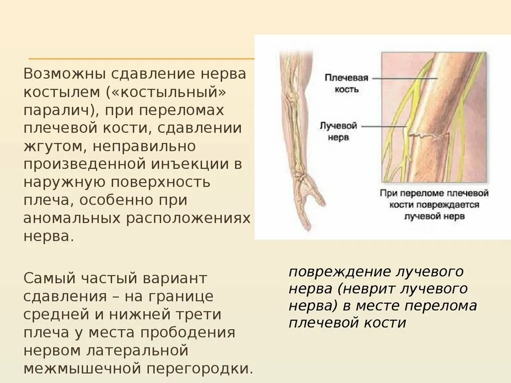 Повреждение локтевого нерва. Повреждение лучевого нерва при переломе. Синдром компрессии лучевого нерва. Поражение лучевого нерва руки при переломе. Симптомы повреждения лучевого нерва при переломах плеча.