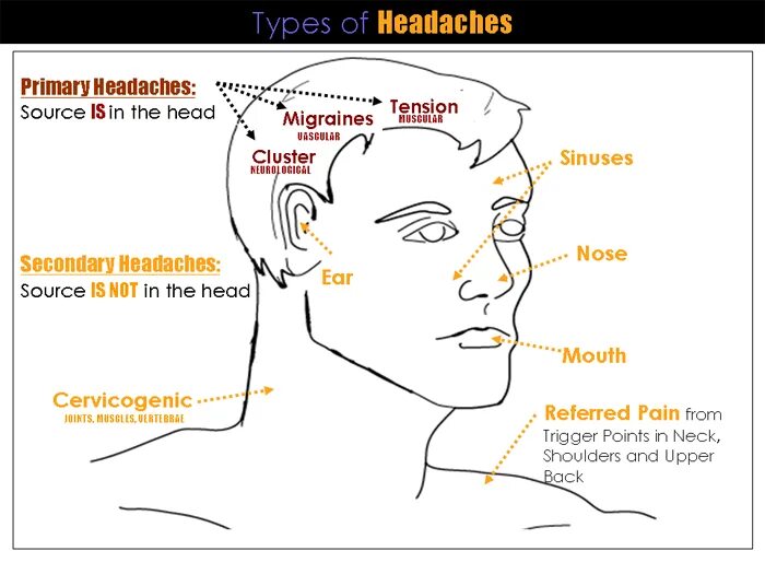 Карта головной боли. Head Pain headaches. Карта боли головы. Headache Types Primary.