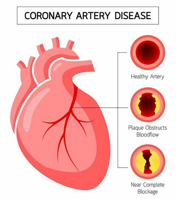 Obesity and coronary artery disease. Атеросклероз коронарных сосудов. Сосуды сердца. Атеросклероз венечных артерий сердца. Coronary disease.