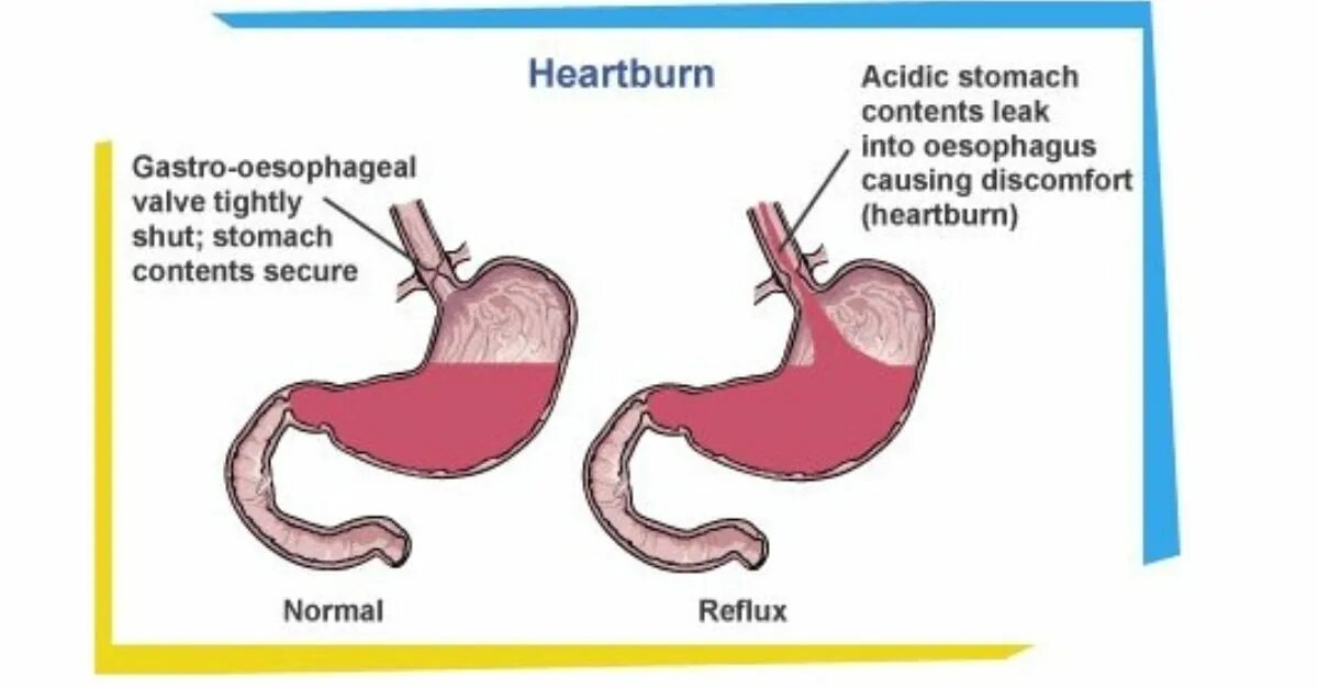 Heartburn перевод. Gastro перевод. This is the way to Kill the bacteria that causes gastritis, Heartburn and other Gastrointestinal problems. Problems that alcohol cause.