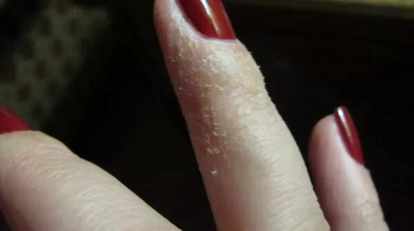 Аллергия на гель лак на руках. Аллергия на гель лак на пальцах. Аллергия на гель лак для ногтей. Аллергия у мастера маникюра