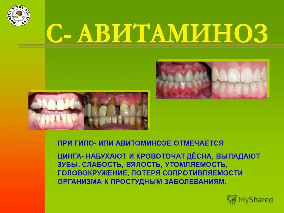 Проявления цинги в полости рта.