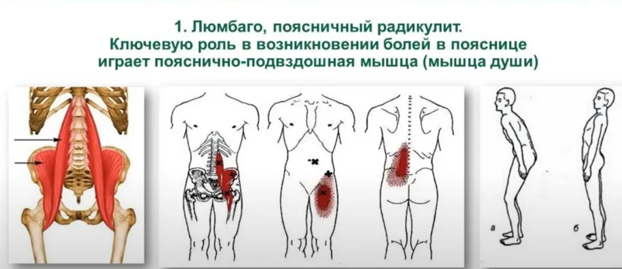 Вертеброгенная люмбалгия. Радикулит люмбаго. Лекарства при люмбаго. Поясни но крестовый радикулит. Люмбоишиалгия поясничного отдела позвоночника.