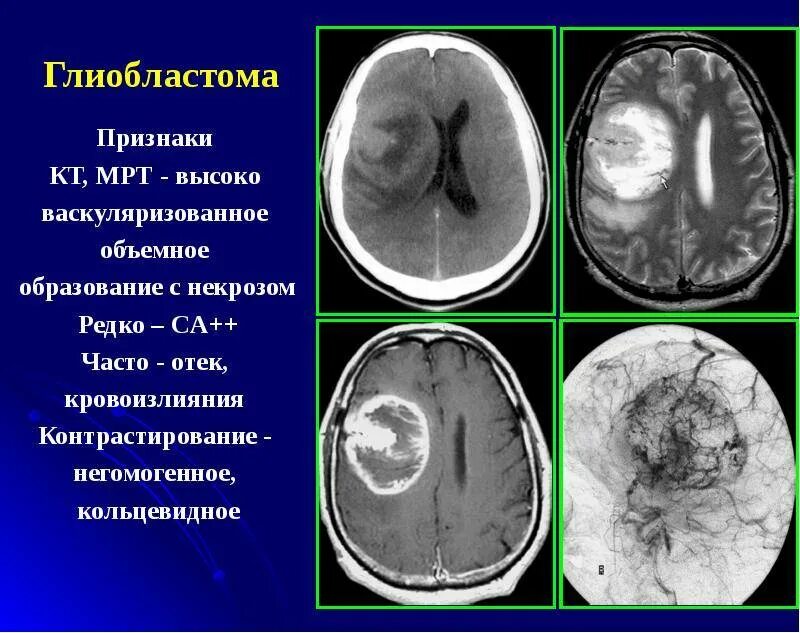 Симптомы опухоли головного мозга на ранних стадиях. Опухоль головного мозга у ребенка. Доброкачественная опухоль головного мозга симптомы. Онкология головного мозга у детей. Признаки опухоли головного мозга.