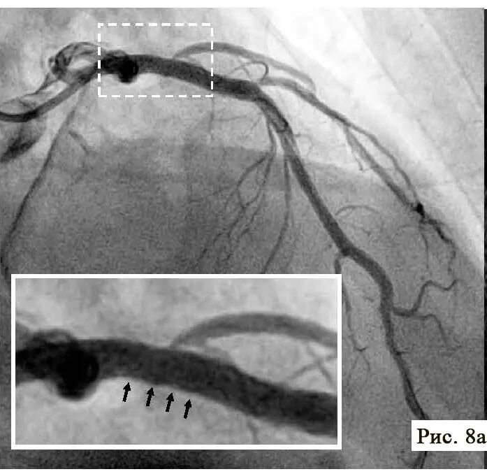 Коронарография стентирование. Коронарография сосудов стентирование. Коронарография стеноз ПМЖВ.