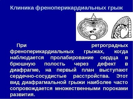Диафрагмальная грыжа