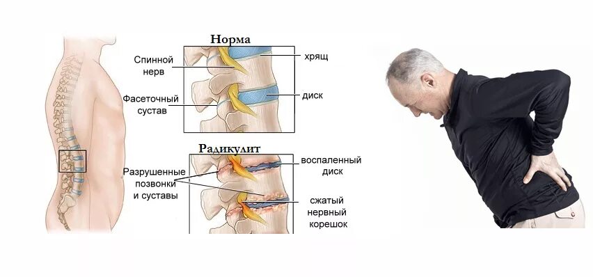 Пульсирует боль в пояснице. Люмбалгия поясничного крестцового отдела. Радикулопатия поясничного отдела. Что такое радикулит пояснично-крестцового отдела. Радикулопатия пояснично-крестцового отдела.