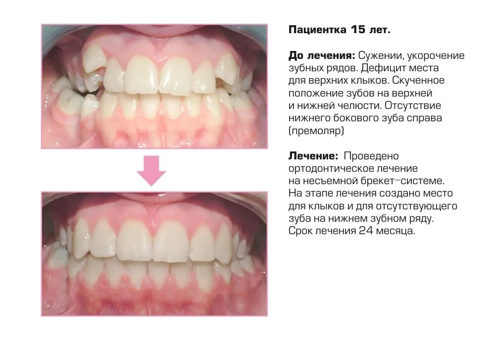 Зубы зубной ряд. Укорочение верхнего зубного ряда.
