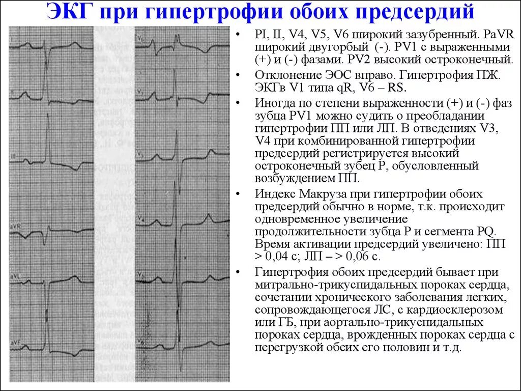 ЭКГ - синдром гипертрофии предсердий.. Гипертрофия правого предсердия v1 v2. Гипертрофия обоих предсердий на ЭКГ. ЭКГ при отклонении ЭОС вправо. Сердце отклонено вправо