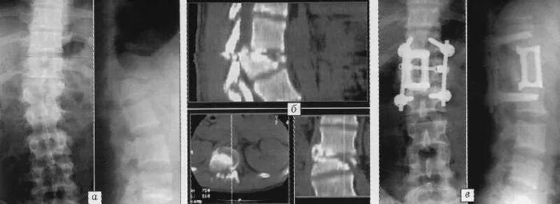 Компрессионно-оскольчатый перелом позвонка рентген. Осколочный перелом позвоночника грудного отдела. Компрессионный перелом позвоночника т12. Перелом позвоночника остеосинтез рентген. Компрессионная операция на позвоночнике