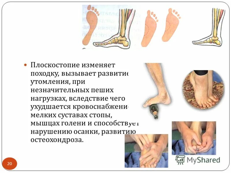 артроз при плоскостопии