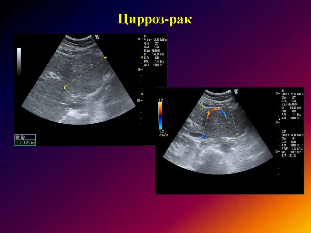 Цирроз печени УЗИ лучевая диагностика. Диффузные поражения печени лучевая диагностика. УЗИ печени Диагностер. Диагноз диффузная печени