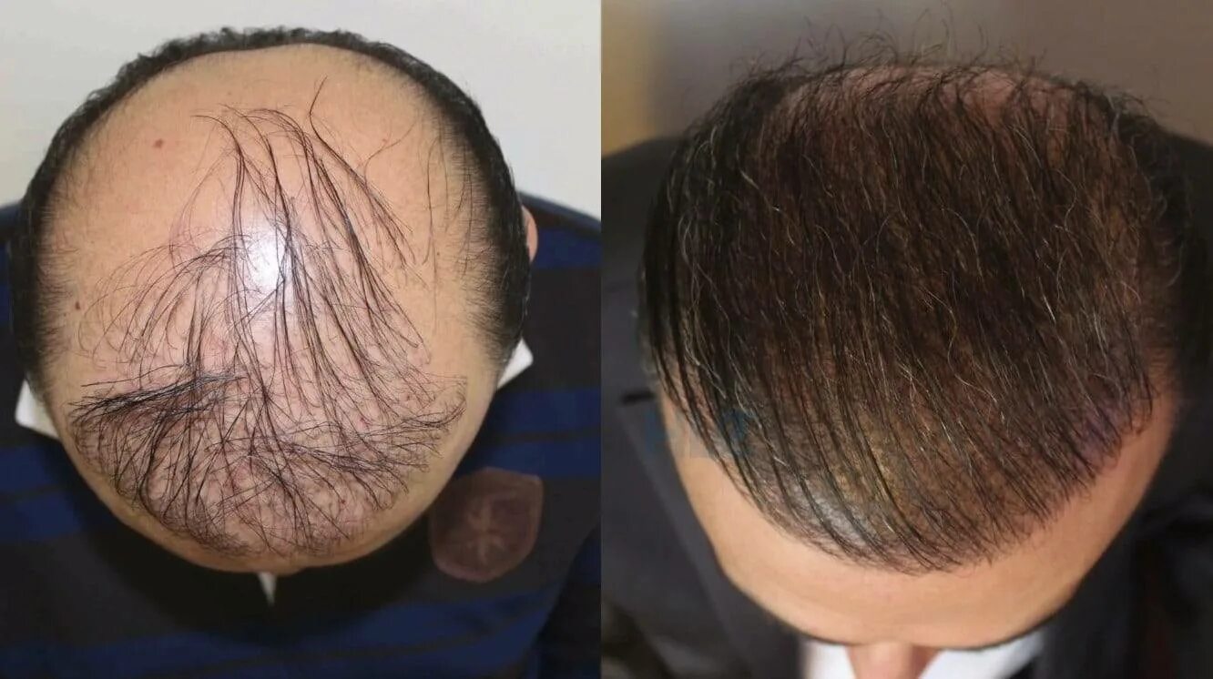 Трансплантация волос на голове. Выпадают волосы после операции