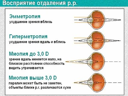 Аккомодация миопия