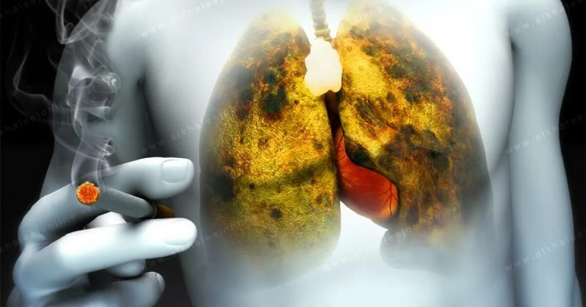 Заболевание курящих людей. Раковые заболевания легких. Онкологические заболевания от курения.