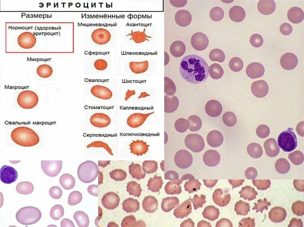Пониженные макроциты. Полихроматофильный нормоцит. Шистоциты. Шистоциты в крови. Эритроциты мишеневидной формы.