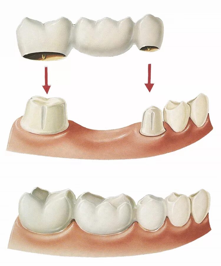 Съемный протез (6-14 зубов) термо джет. Пластиковые зубы. Внутрикостная дентальная имплантация. Несъёмные мостовидные шинирующие протезы. Съемные протезы передних зубов.