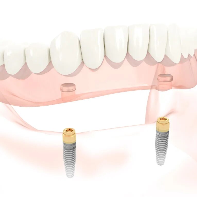 Покрывной протез на 2 имплантах. Покрывной протез на имплантах. Протез на аттачменах на имплантах. Полносъемный протез на имплантах. Как крепятся съемные